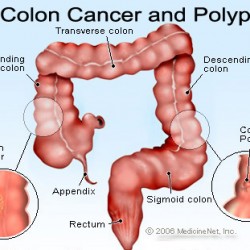 cancer de colon mujer